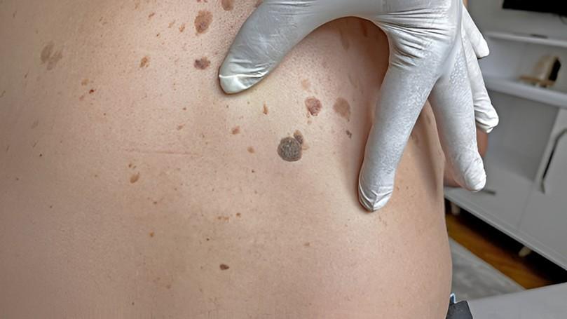 Deadly Skin Cancer Signs You Might Be Missing
