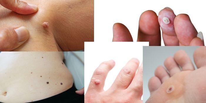 Examples of a skin tag on the neck, moles on the abdomen and warts on the hand, finger and foot