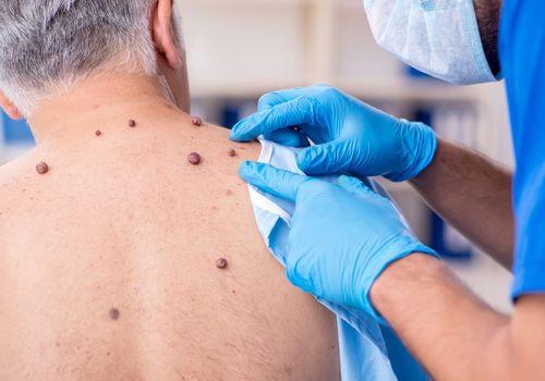 GP examining moles and skin growths on a patient's back before skin tag and mole removal at Harbour Town Doctors, Gold Coast